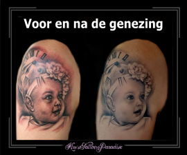 baby portret voor en na de genezing bovenarm